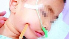 Vừa ăn cơm vừa xem hoạt hình, bé 2 tuổi bị đũa đâm vào hộp sọ 