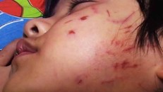 Bé 4 tuổi bị bạn cào rách mặt: 'Cần dạy trẻ ứng phó với bắt nạt'