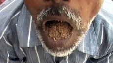 Kì lạ người đàn ông có sở thích ăn cát sỏi suốt 25 năm