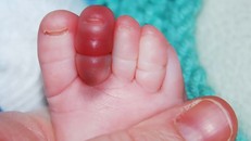 Trẻ có thể mất ngón chân tay chỉ vì... một sợi tóc rụng