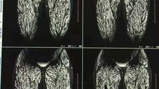  Kinh dị sán chiếm lĩnh cơ thể người phụ nữ do ăn thịt lợn sống