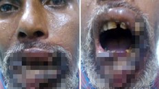 Rùng mình người đàn ông có dòi lúc nhúc sống trong miệng