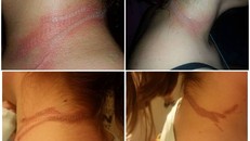 Gặp sự cố bất ngờ từ smartphone, bé gái mang sẹo cả đời