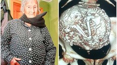 60 năm thai nhi nằm trong bụng bà cụ 91 tuổi mà không biết