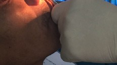 Rùng mình đỉa 'làm tổ' trong hốc mũi người đàn ông ở Ninh Thuận