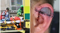 Bị cắt lìa tai vì ngồi xe buýt 2 tầng ở Anh