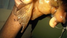 Hotgirl bị lột da toàn thân và hôn mê sâu vì thuốc nhỏ mắt