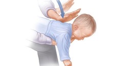 Cách sơ cứu trẻ nhỏ bị mắc dị vật đường hô hấp