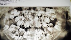 Kỳ lạ bé trai 9 tuổi có 300 chiếc răng