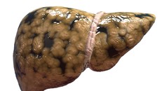 Những thực phẩm cấm kị với người gan nhiễm mỡ