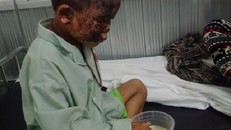 Cậu bé bị bỏng cả khuôn mặt do lấy xăng nhóm bếp