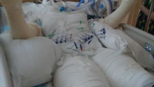 Thiếu nữ bỏng nặng vì học theo trào lưu điên rồ trên mạng xã hội