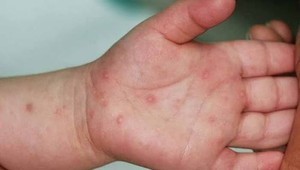 Bệnh tay chân miệng vào mùa, xuất hiện nhiều ca nặng phải thở máy​