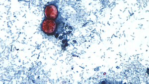 Các trường hợp nhiễm ký sinh trùng Cyclospora thường gia tăng vào mùa xuân và mùa hè ở Mỹ.