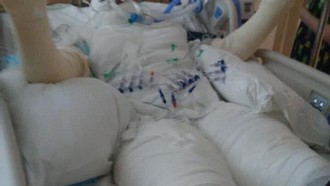 Thiếu nữ bỏng nặng vì học theo trào lưu điên rồ trên mạng xã hội