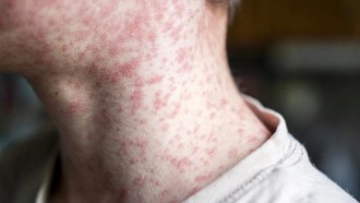 Nguy cơ bệnh sởi lan rộng tại châu Mỹ