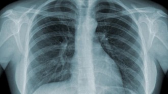 Phát hiện cơ chế gây viêm phổi thứ phát sau lao