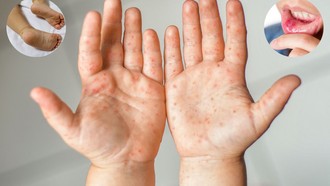 Tay chân miệng gia tăng, Bộ Y tế yêu cầu tăng cường phòng dịch tại trường học