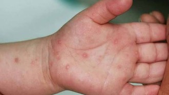 Bệnh tay chân miệng vào mùa, xuất hiện nhiều ca nặng phải thở máy​