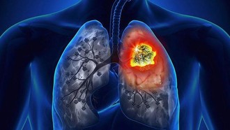 Mô hình AI dự đoán gene ung thư phổi với độ chính xác tới 90%