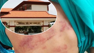 Vết thương của học sinh lớp 1 do bị bạn bạo hành và trường Tiểu học Bình An (ảnh nhỏ).