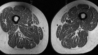 Ảnh chụp MRI vùng đùi của một phụ nữ với chế độ ăn có đến 87% là thực phẩm siêu chế biến.