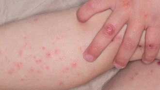 Bệnh tay chân miệng ở trẻ em.