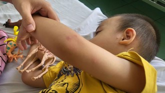 Bệnh tay chân miệng gia tăng, khuyến cáo phòng bệnh trong trường học