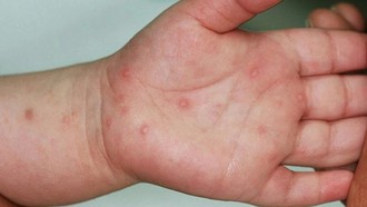 Số trẻ mắc bệnh tay chân miệng tăng gấp 3,5 lần so với cùng kỳ năm trước