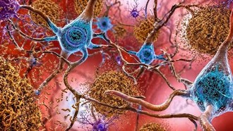 Phương pháp mới giúp phát hiện sớm bệnh Alzheimer