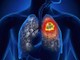 Mô hình AI dự đoán gene ung thư phổi với độ chính xác tới 90%