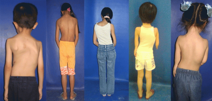 Trẻ bị cong vẹo cột sống vì những lý do đơn giản bố mẹ thường bỏ qua ảnh 1