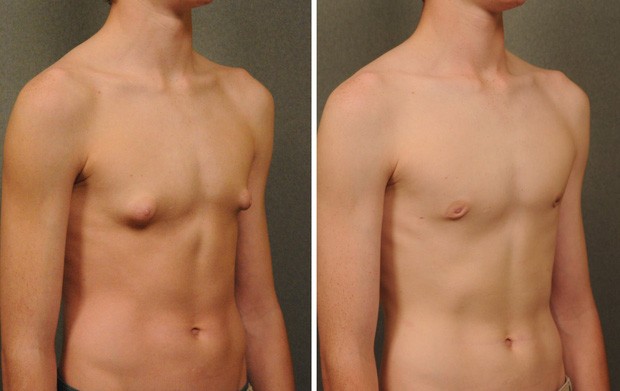 Cơ thể thiếu loại hormone này, ngực nam giới có thể phát triển to giống nữ giới - ảnh 2