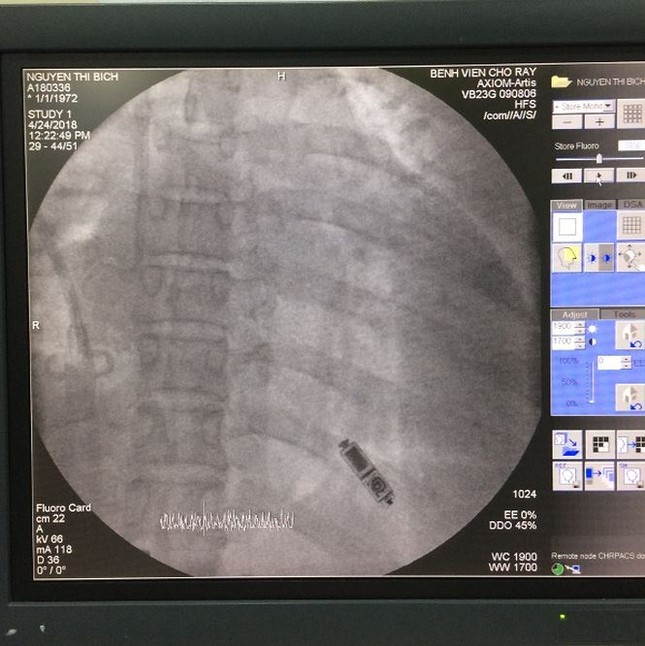 Bệnh viện Chợ Rẫy đặt máy tạo nhịp tim không dây thành công - ảnh 4