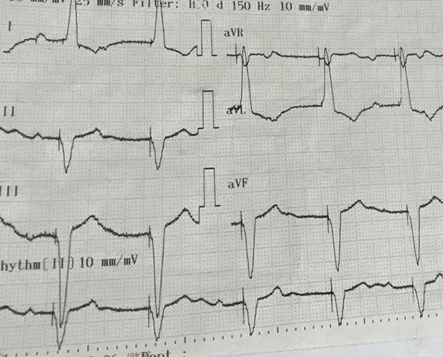 Bệnh viện Chợ Rẫy đặt máy tạo nhịp tim không dây thành công - ảnh 3