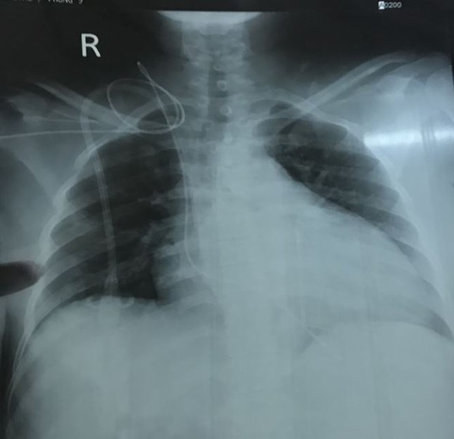 Bệnh viện Chợ Rẫy đặt máy tạo nhịp tim không dây thành công - ảnh 2
