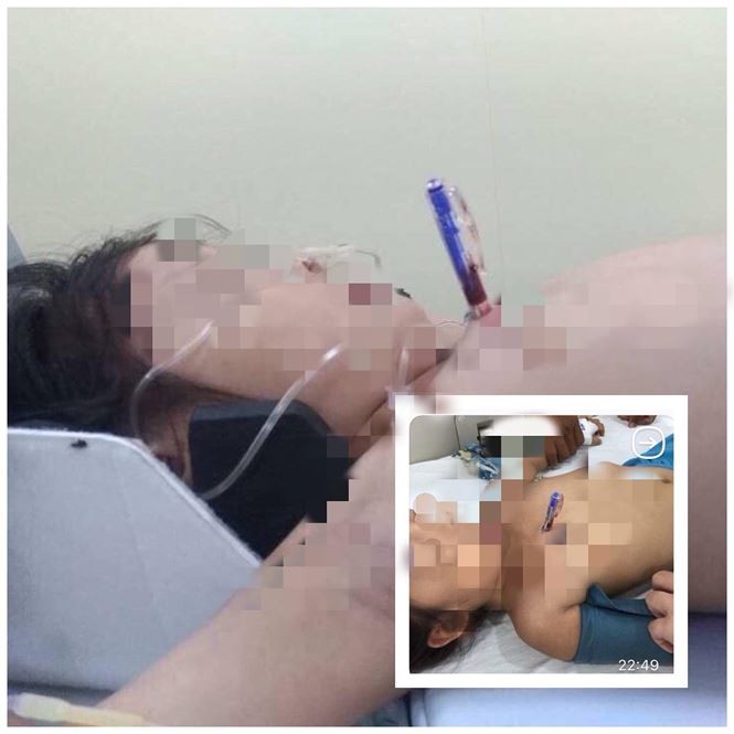 Vấp té khi cầm bút chơi, bé gái suýt chết vì bút đâm xuyên ngực ảnh 1