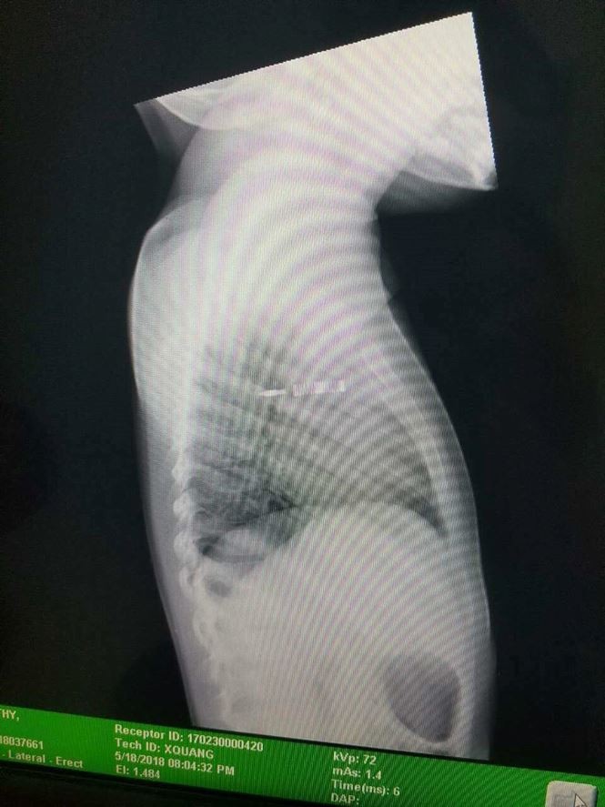 Vấp té khi cầm bút chơi, bé gái suýt chết vì bút đâm xuyên ngực ảnh 2