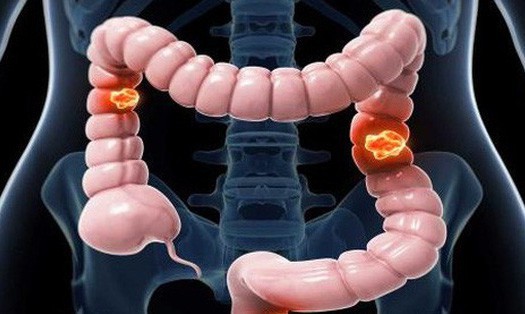 Tuyên Quang: 8 người trong một gia đình bị ung thư đại tràng ảnh 1