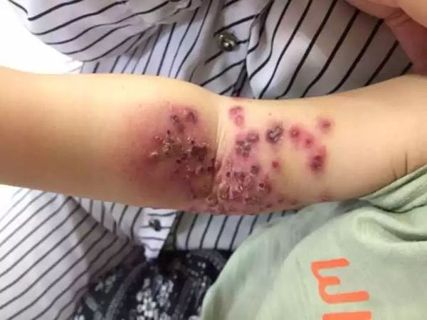 Bé 18 tháng tuổi sưng rộp, lở loét cánh tay vì nụ hôn của mẹ ảnh 1