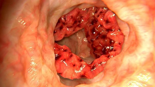 Cảnh báo ung thư đại trực tràng tăng báo động ở người trẻ vì thói quen này ảnh 1