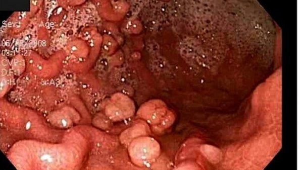 Cảnh báo ung thư đại trực tràng tăng báo động ở người trẻ vì thói quen này ảnh 2