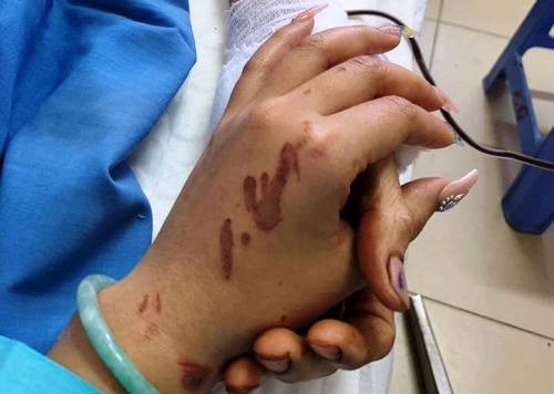 Nạn nhân bị tạt axit ở Quảng Ngãi: 'Tôi cứ tưởng là cướp' ảnh 3