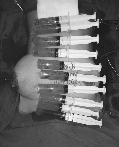 Một phụ nữ bị biến chứng vòng 1 như quả bóng bay kích thước 50cm ảnh 1