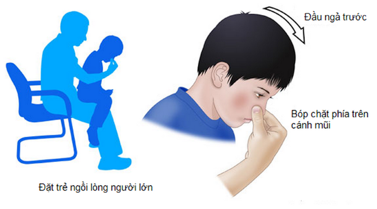 Xử trí thế nào khi trẻ bị chảy máu cam? ảnh 1