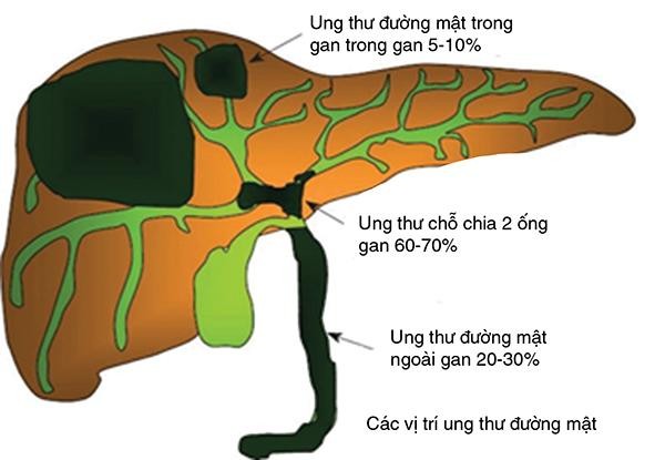 Vàng da có thể là một dấu hiệu của ung thư đường mật ảnh 1