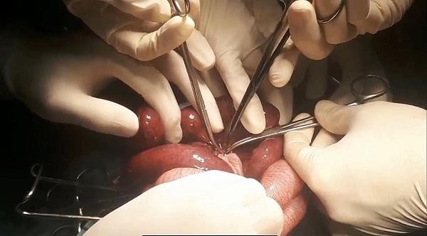 Ruột hoại tử do xoắn ruột ở trẻ 45 ngày tuổi ảnh 1