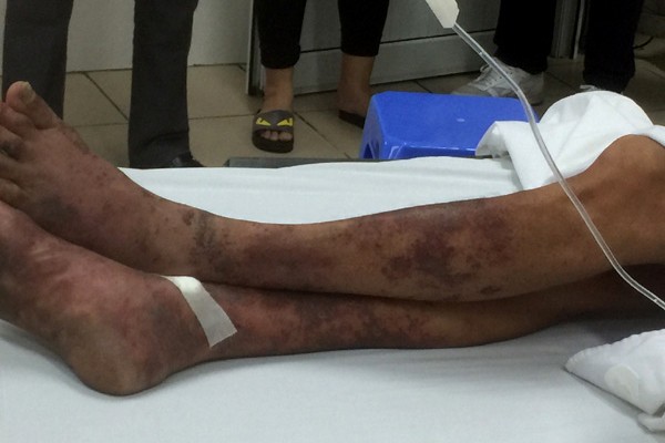 Mất mạng vì nhiễm liên cầu lợn ảnh 1