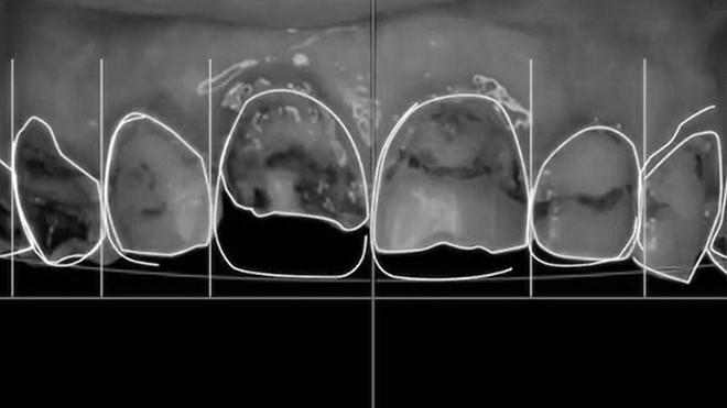 Nước ngọt có ga - kẻ thù của răng miệng ảnh 1