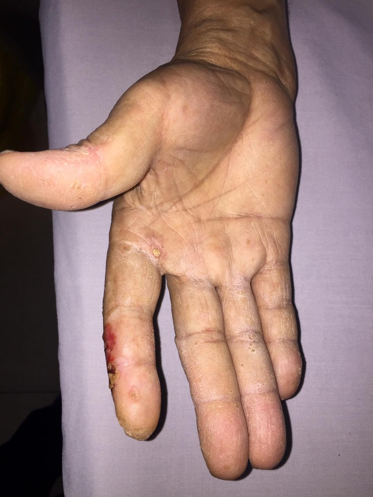 Nhiễm độc asen lâu ngày dễ biến chứng thành ung thư da ảnh 1